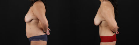 Tummy Tuck case #7626