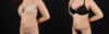 Liposuction case #6119 slider thumbnail