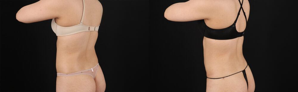 Liposuction case #6119