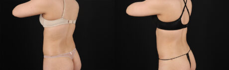 Liposuction case #6119