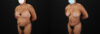 Tummy Tuck case #7468 slider thumbnail