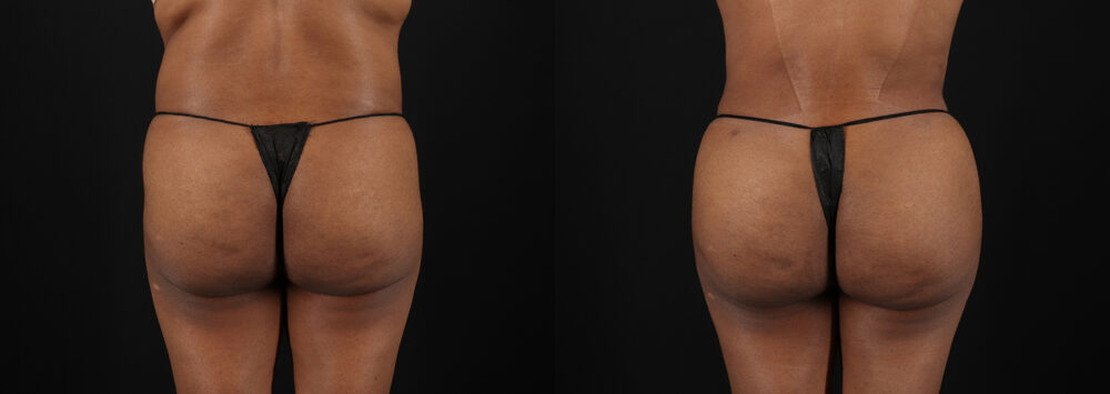 Tummy Tuck case #7468