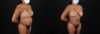 Tummy Tuck case #7468 slider thumbnail