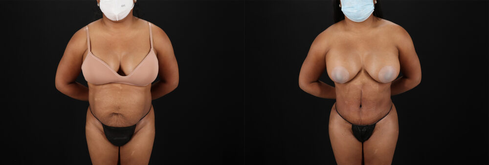 Tummy Tuck case #7468