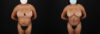 Tummy Tuck case #7468 slider thumbnail
