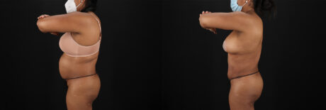 Tummy Tuck case #7468