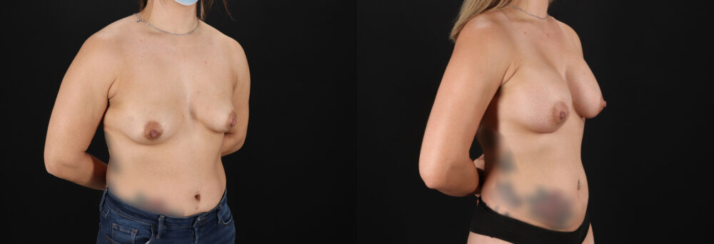 Breast Augmentation case #6408