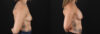 Breast Augmentation case #6408 slider thumbnail