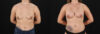 Breast Augmentation case #6408 slider thumbnail