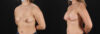 Breast Augmentation case #6408 slider thumbnail