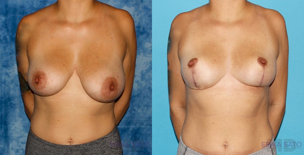 Breast Reduction case #7931