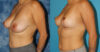 Breast Reduction case #7931 slider thumbnail