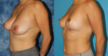Breast Reduction case #7931