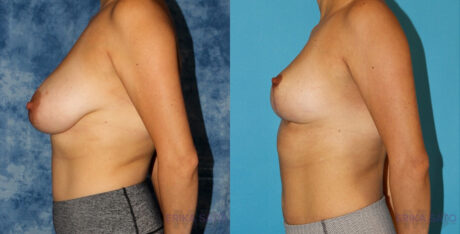 Breast Reduction case #7931