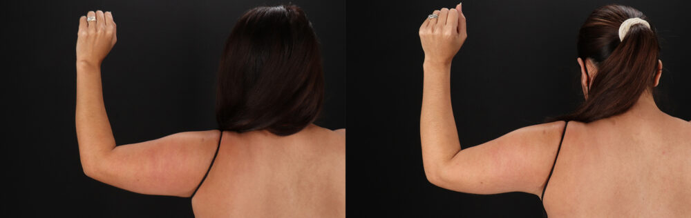 Tummy Tuck case #7470