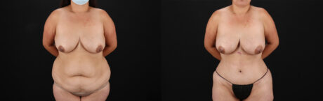 Tummy Tuck case #7470