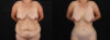 Tummy Tuck case #7470 slider thumbnail