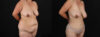 Tummy Tuck case #7470 slider thumbnail