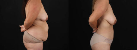 Tummy Tuck case #7470