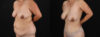 Tummy Tuck case #7470 slider thumbnail