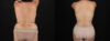Tummy Tuck case #7470 slider thumbnail