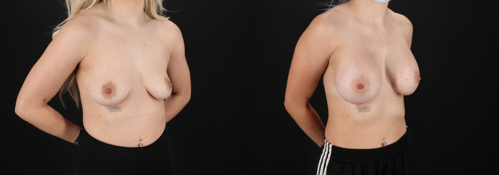 Breast Augmentation case #6414
