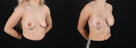 Breast Augmentation case #6414