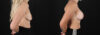 Breast Augmentation case #6414 slider thumbnail