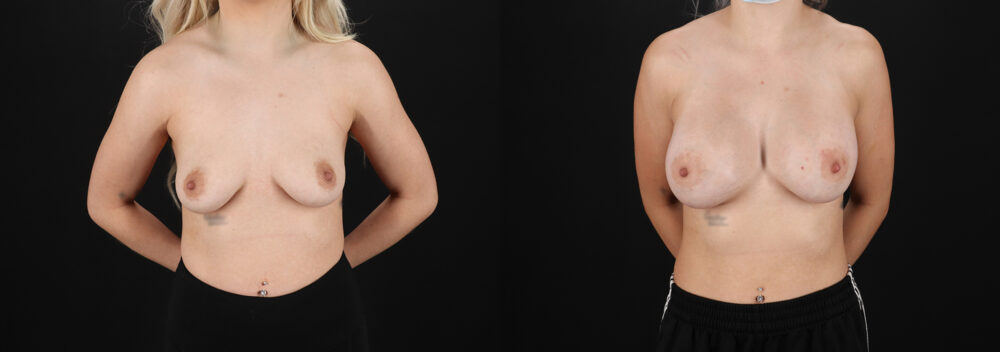 Breast Augmentation case #6414