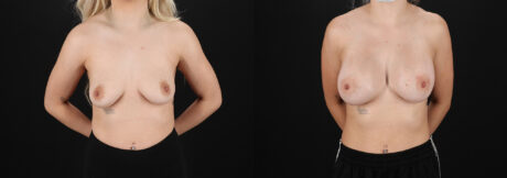 Breast Augmentation case #6414
