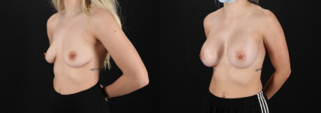 Breast Augmentation case #6414