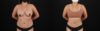 Tummy Tuck case #7471 slider thumbnail