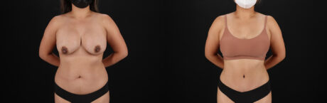 Tummy Tuck case #7471