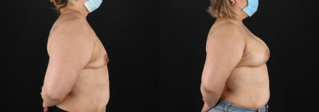Breast Augmentation case #6420