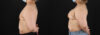 Breast Augmentation case #6420 slider thumbnail