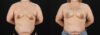 Breast Augmentation case #6420 slider thumbnail