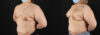 Breast Augmentation case #6420 slider thumbnail
