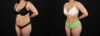 Brazilian Butt Lift case #5391 slider thumbnail