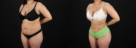Brazilian Butt Lift case #5391