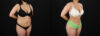 Brazilian Butt Lift case #5391 slider thumbnail