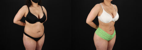 Brazilian Butt Lift case #5391