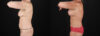 Mommy Makeover case #6684 slider thumbnail