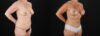 Mommy Makeover case #6684 slider thumbnail