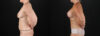 Mommy Makeover case #6684 slider thumbnail