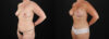 Mommy Makeover case #6684 slider thumbnail