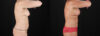 Mommy Makeover case #6684 slider thumbnail