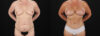Mommy Makeover case #6684 slider thumbnail