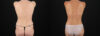 Mommy Makeover case #6684 slider thumbnail
