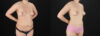 Liposuction case #6120 slider thumbnail