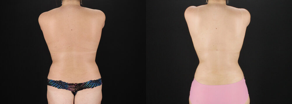 Liposuction case #6120